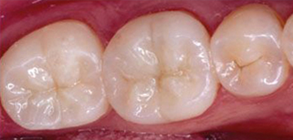 Tooth Colored Fillings
