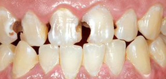 Tooth Fillings Before
