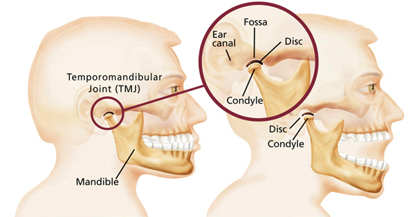 Temporomandibular Disorder Image